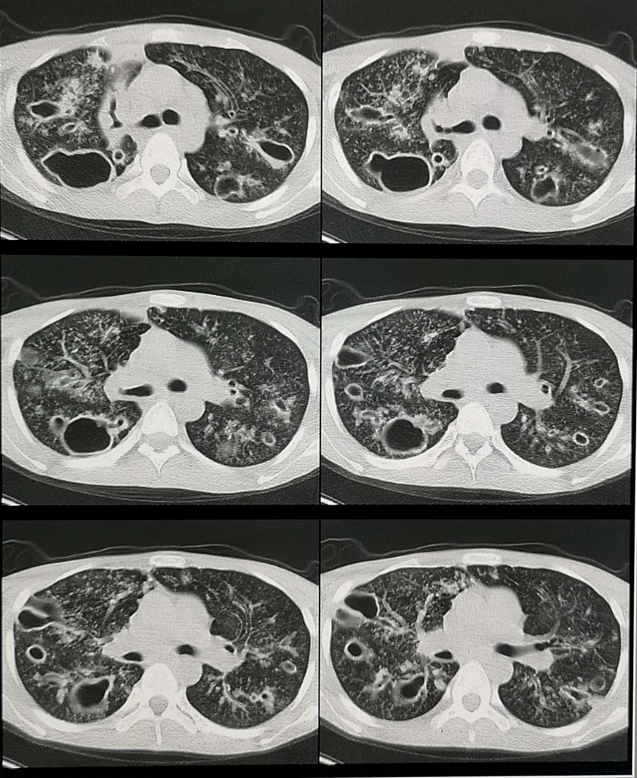 网吧小伙感染肺结核,在网吧得了肺结核