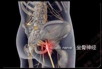 坐骨神经痛该如何科学进行康复?