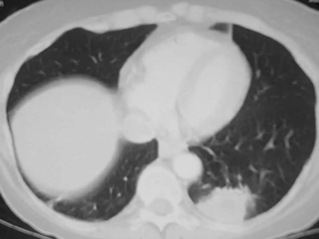 肺炎炎症图片,肺炎病历单图片