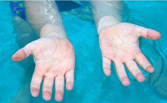 为什么手指泡水会有坑,手指为什么泡水特别容易烂