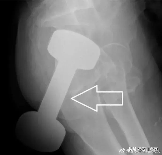 一条罗非鱼“游”进肛门？医生：直肠不直，进去容易出来难