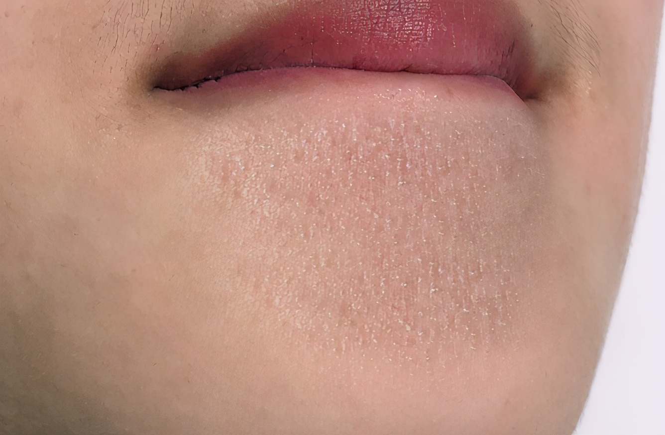 下巴不停长白色粉刺,下巴闭合粉刺挤出来白色的