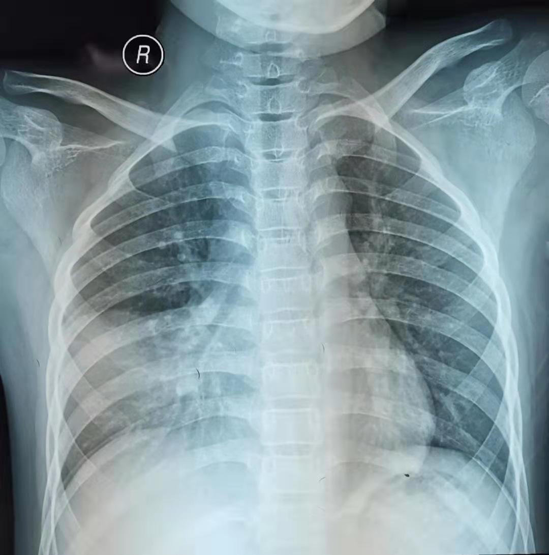 流感还没好利索能喝川贝枇杷膏么,流感还没好又感冒