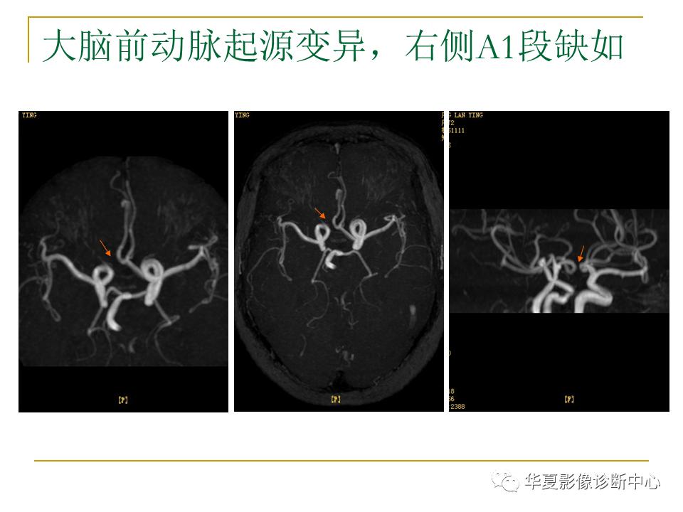 中国人脑立体定向mri应用解剖图谱,脑mri示意图