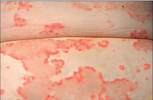 干燥综合征是什么样的症状,干燥综合征是什么样的