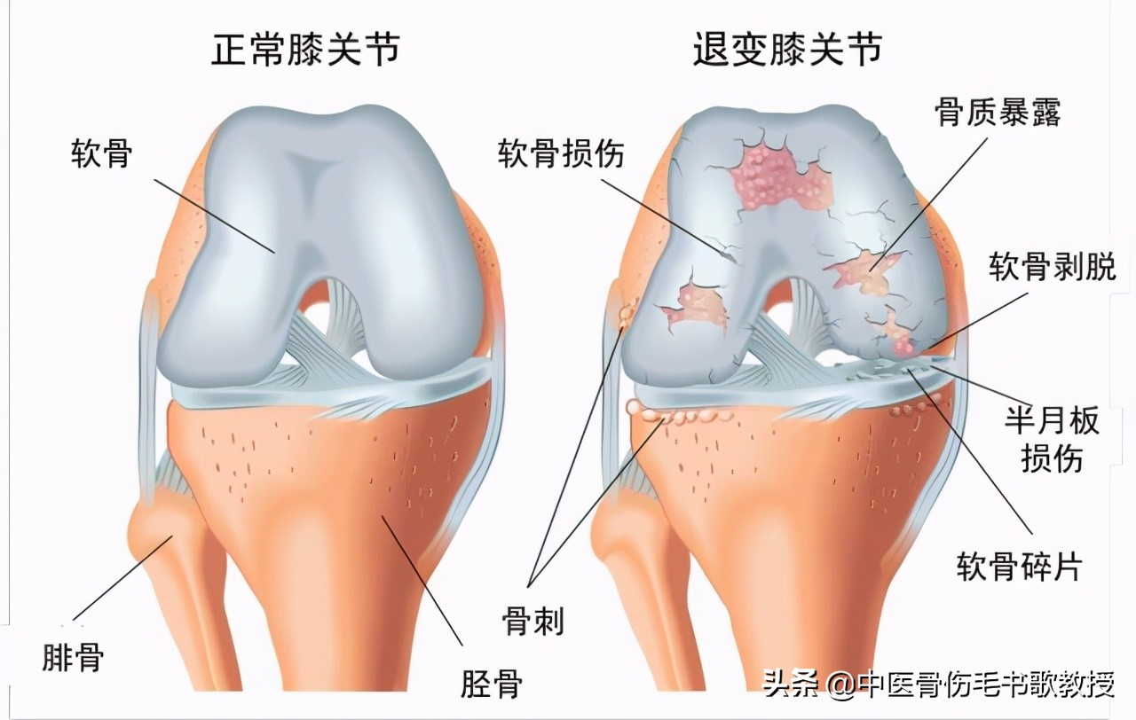 手指关节痛属于风湿还是类风湿,手指关节僵硬膝盖都疼是什么病兆