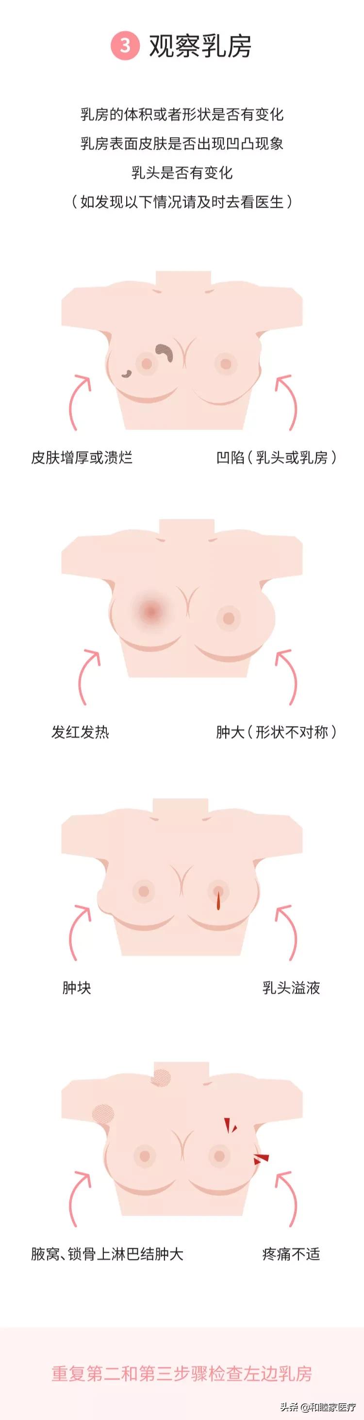 怎么自测乳腺增生症状,怎样自测是乳腺增生还是乳房堆奶