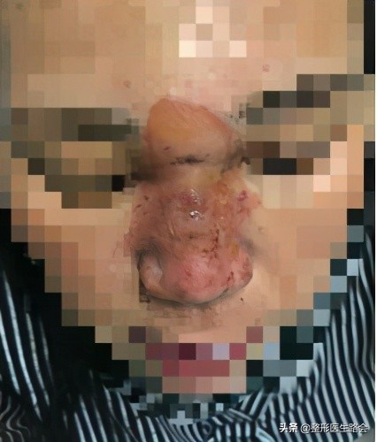 去除法令纹要先打苹果肌吗,去除法令纹可以打除皱针吗