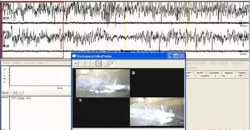 癫痫病人的最主要护理措施,癫痫病人怎样才算全部康复