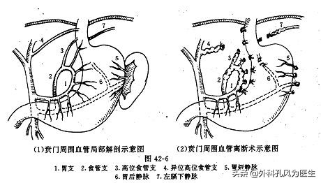 肝硬化引起的门脉高压严重吗,肝硬化为什么导致门脉高压升高