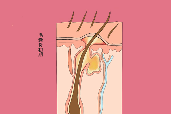 头皮瘙痒有疙瘩有小米粒怎么办,头皮瘙痒起疙瘩用什么清洗