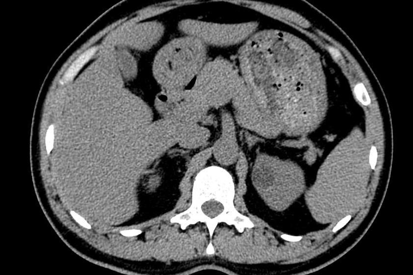 垂体瘤患者ACTH很低,ACTH缺乏症