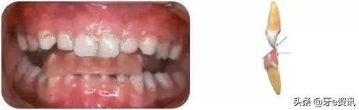 乳牙地包天会自动好吗,乳牙地包天矫正活动器