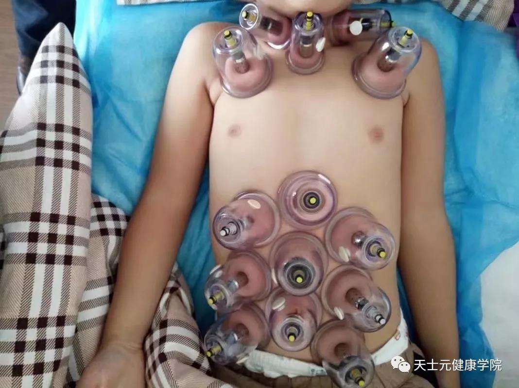 小孩腺样体肥大可以中药调理好吗,孩子腺样体肥大容易上火怎么调理