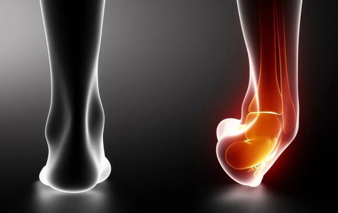 踝关节在崴脚是经常内翻还是外翻,经常崴脚怎么加强踝关节力量