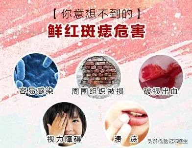 诊治鲜红斑痣过程中需要注意哪些东西