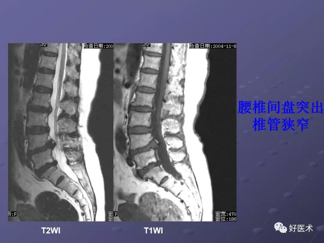 脊柱mri有哪些特点,乳腺疾病的mri诊断及鉴别