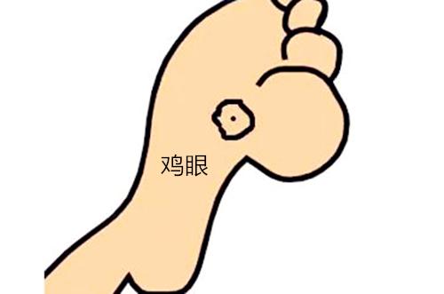 切记不要把跖疣当作鸡眼处理,跖疣和鸡眼到底怎么区分