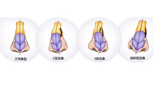 丑鼻子三大特点,10种难看的鼻子