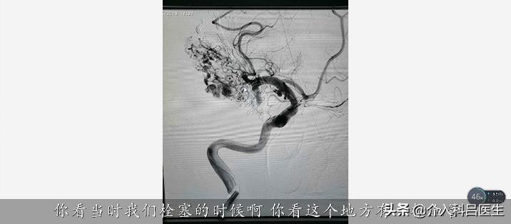 53岁先天性动静脉畸形导致脑出血,50岁大姐脑梗