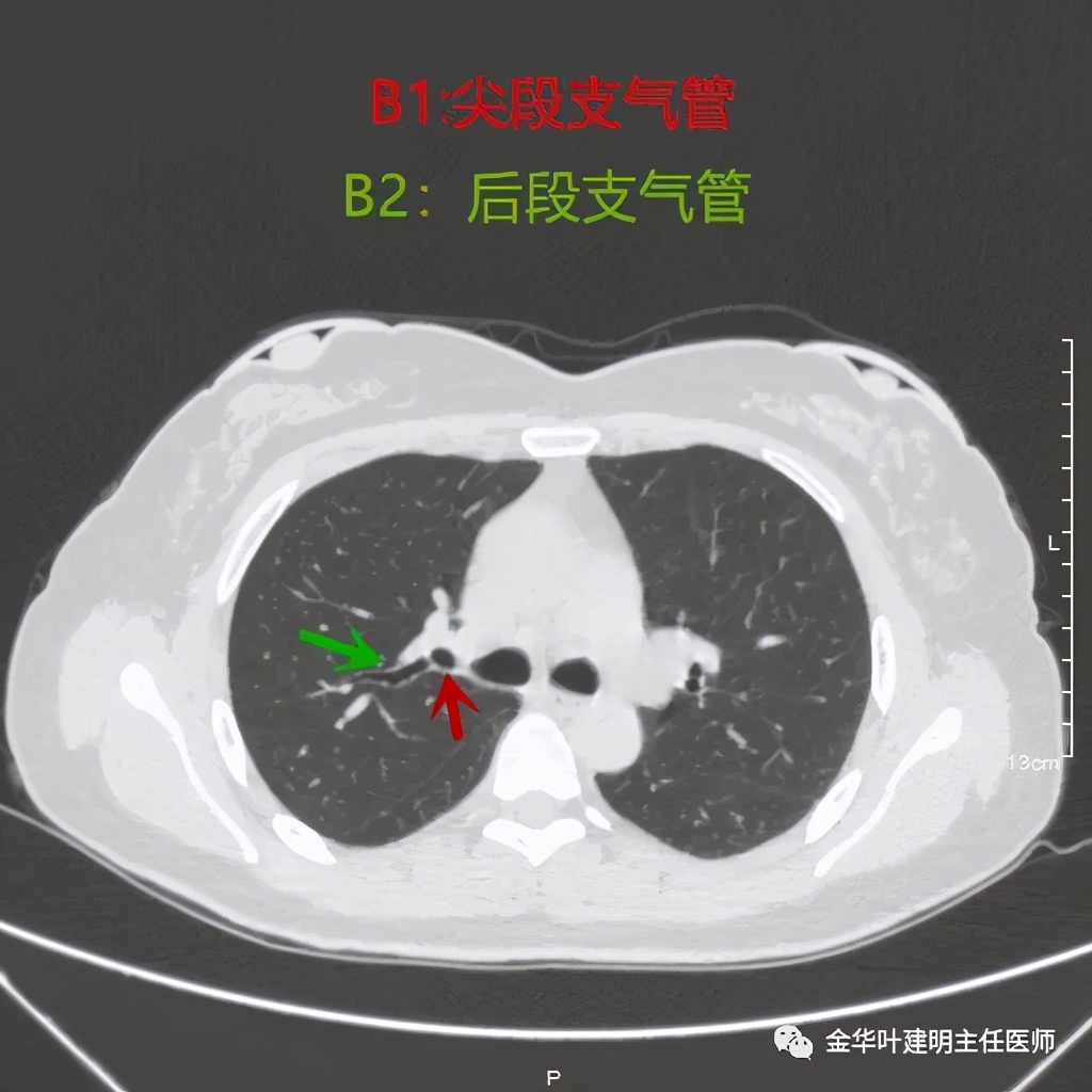左肺上叶在ct影像上怎么看,平扫ct可以看出肺肿瘤的变化吗