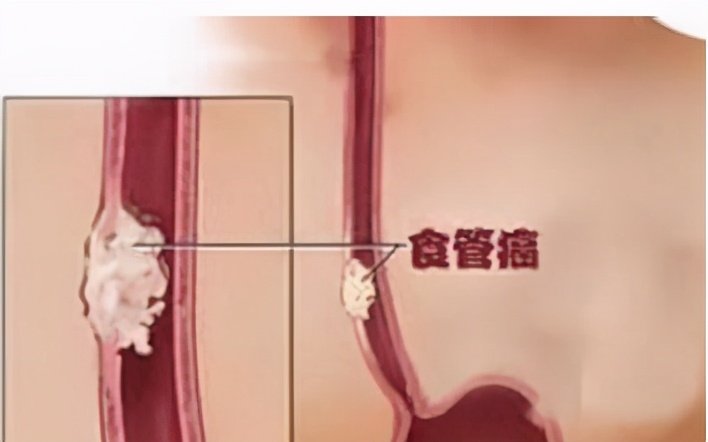 食管癌最怕的克星,改掉不良的嗜好