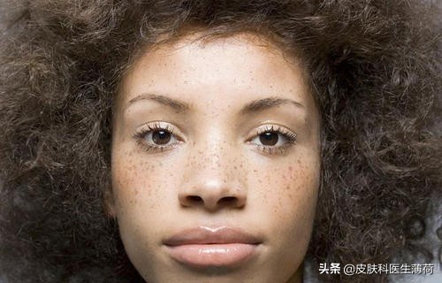 脸上有斑是做冷冻还是激光,黄褐斑用激光祛好还是吃中药