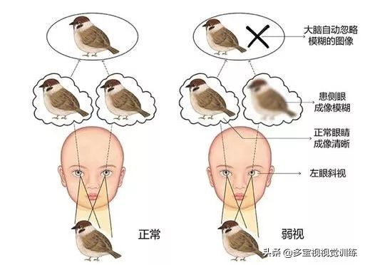 孩子弱视和斜视一般是先治弱视吗,孩子有斜视可以矫正吗