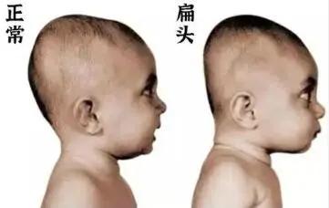 一岁宝宝睡偏头戴婴儿矫正头盔,七个月宝宝戴头盔多久能纠正头型