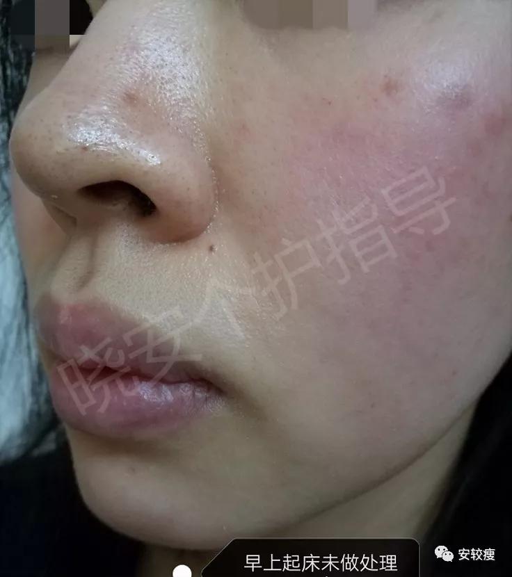 皮炎疹子干燥泛红,秋冬皮肤泛红发烫