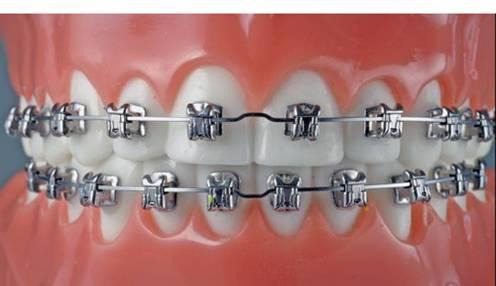 陶瓷还能用来做矫正?怎么做到的?