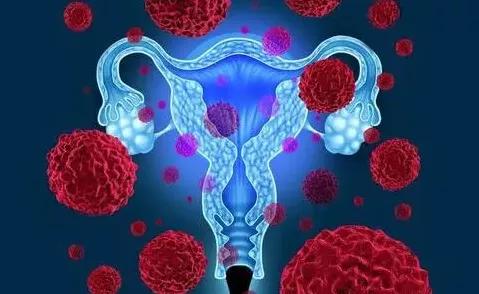 免疫细胞回输治疗宫颈癌,免疫细胞疗法可以有效预防癌症