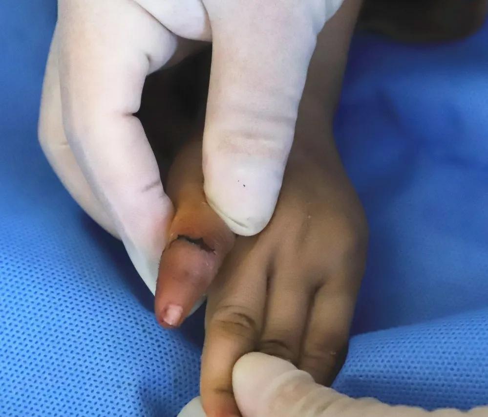 断指再植接动脉显微镜视频,穿针引线手术