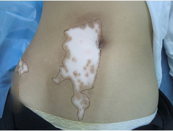 白癜风是否在康复？需要满足这5个条件