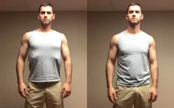 怎么能快速治疗肋骨外翻,如何矫正肋骨外翻