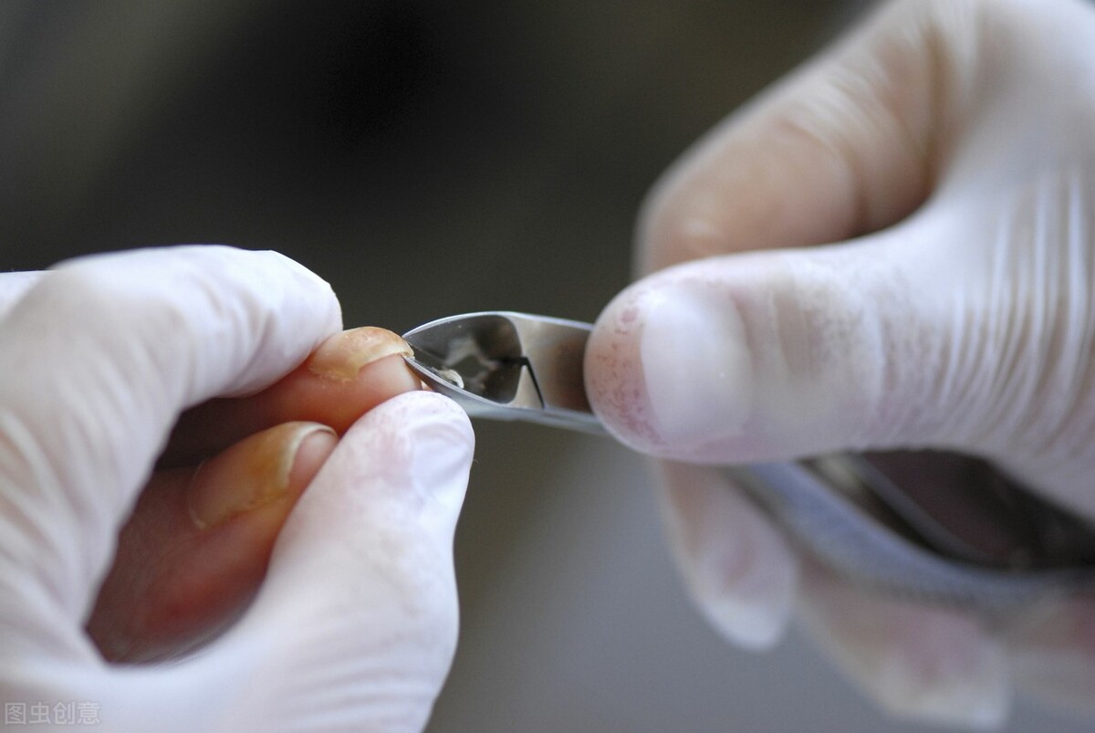 糖尿病为什么会出现糖尿病足呢,糖尿病怎么不出现糖尿病足