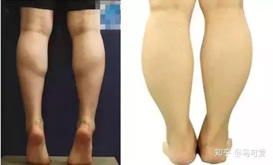 小腿粗可以通过运动改善吗,小腿能粗到什么地步