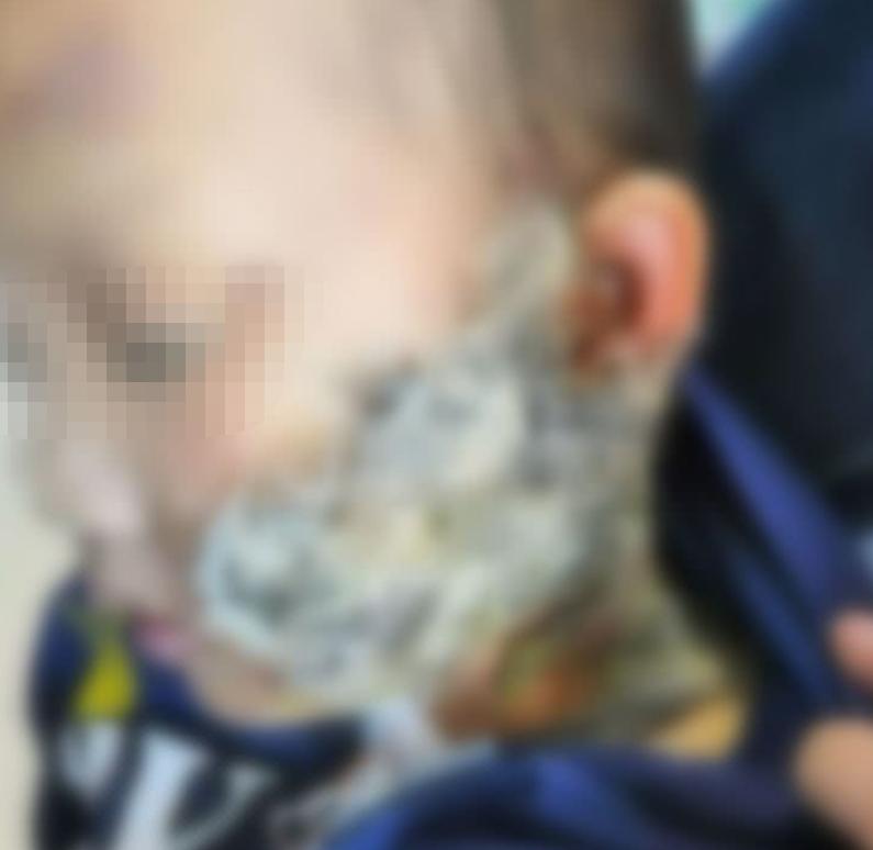 烫伤小孩送医院,4岁小孩烫伤被送进icu