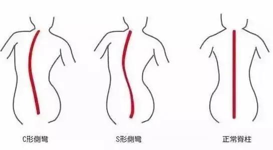 高低肩你怎么改善,怎样塑造好气质直角肩