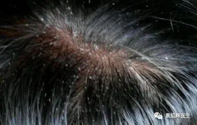 头皮脂溢性皮炎头皮屑发红,银屑病和脂溢性皮炎头皮屑的区别