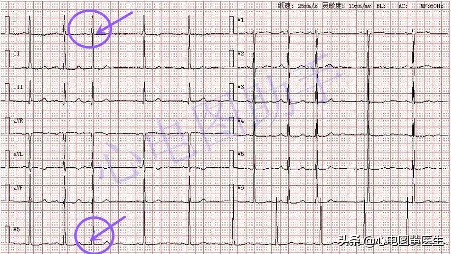 窦房结内游走性心律是什么意思,窦房结内游走性心律不齐