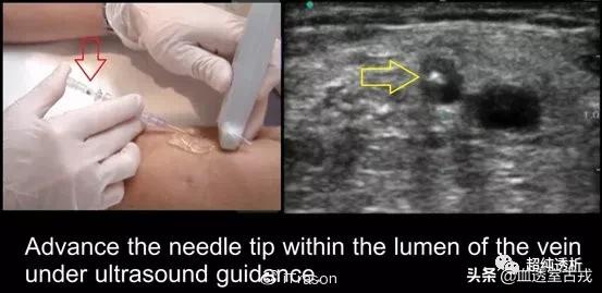 超声引导下血管穿刺效果评价,超声引导下血管穿刺置管流程