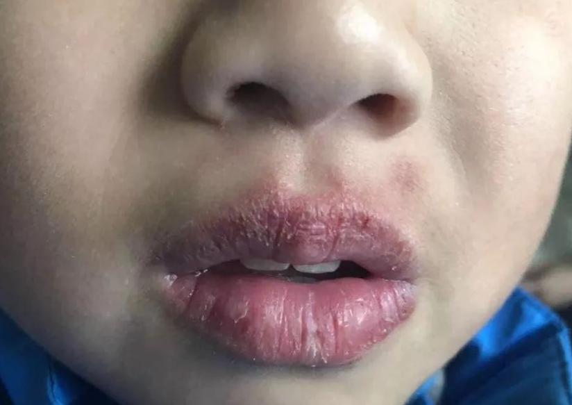 去秋燥内火吃什么,推荐10种食物败火去秋燥