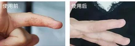 抗痘抑菌凝胶,祥顺比尔霍夫抑菌凝胶治理皮癣