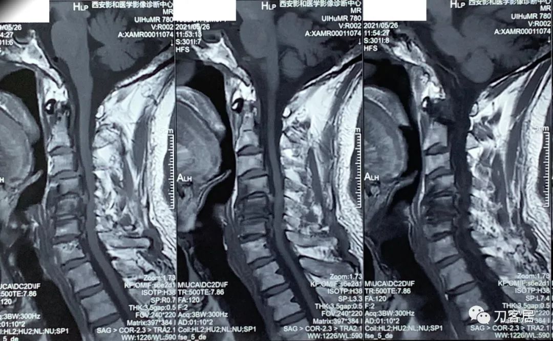 颈椎病椎间盘突出医生说先不手术,颈椎3-7节椎间盘突出怎么治疗