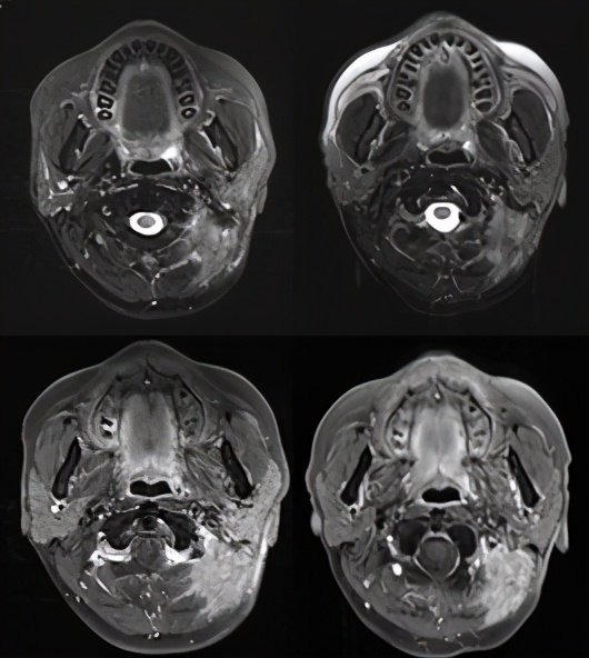 pd-1抑制剂适用的肿瘤类型,pd-1抑制剂能用于癌症晚期么