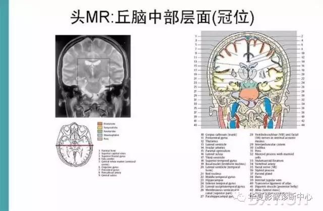 电子版头颅ct与mri断层解剖,头颅mri血管解剖与分段详解