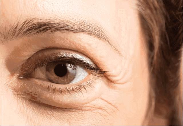 眼周长脂肪粒了怎么办,眼周长脂肪粒怎么处理