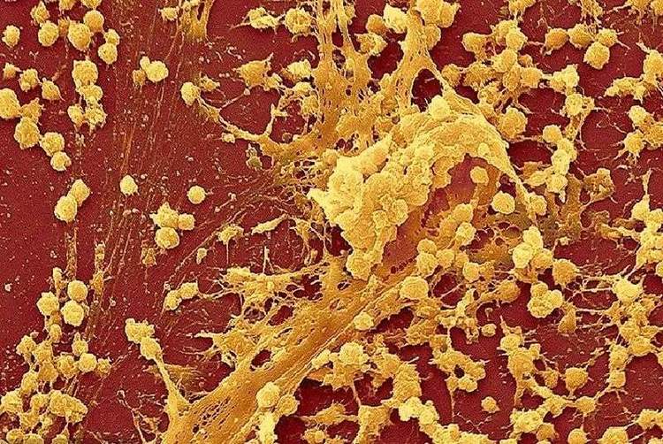 化脓性肺炎，硬扛3天不吃抗生素必后悔，这个细菌专治各种不服