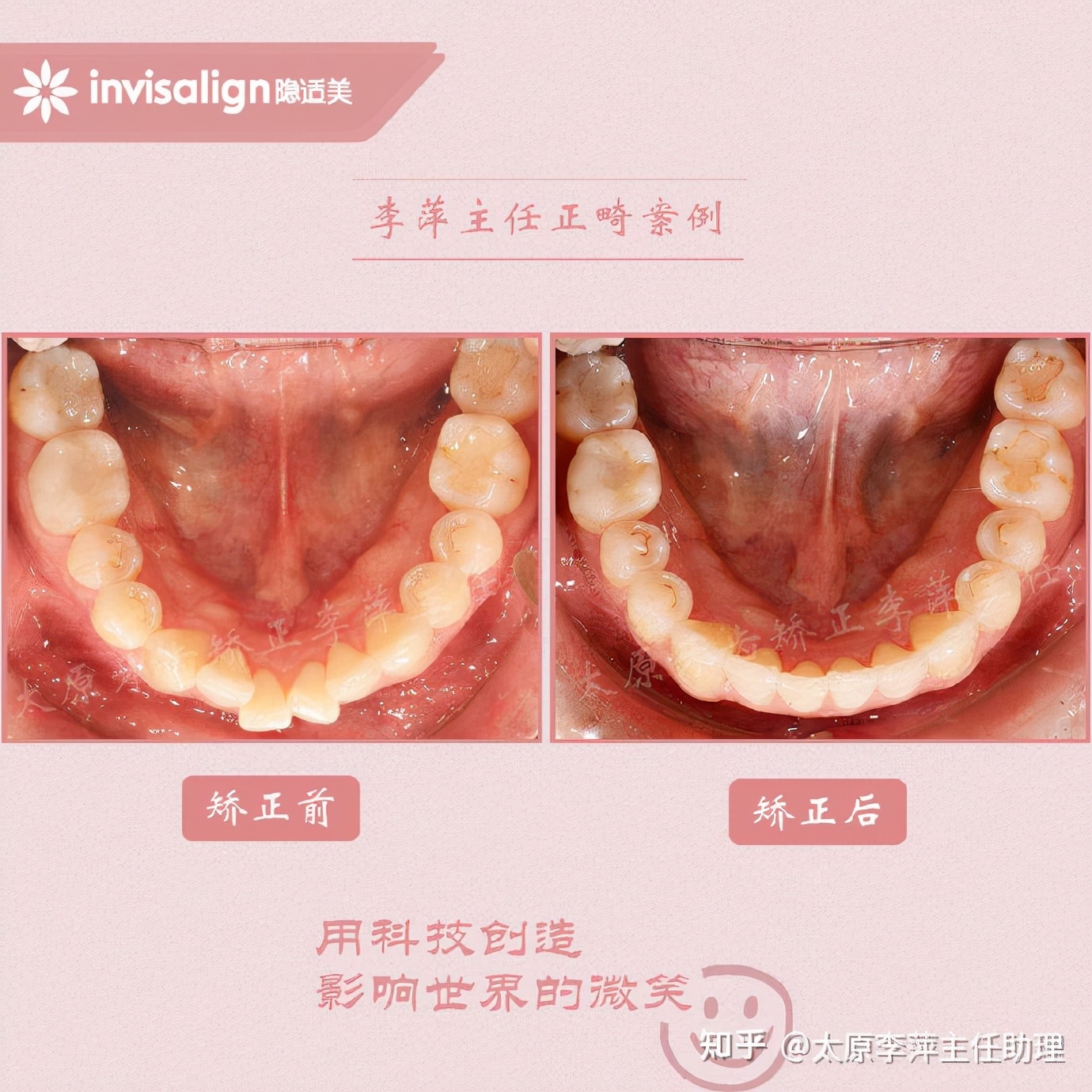 重度拥挤矫正牙齿适合隐形牙套吗,广州成人牙齿矫正推荐隐形牙套